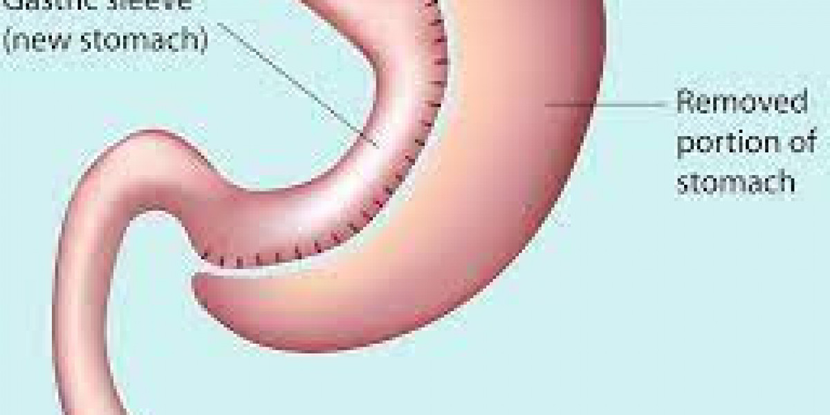 How does the cost of gastric sleeve surgery in Turkey compare to other countries