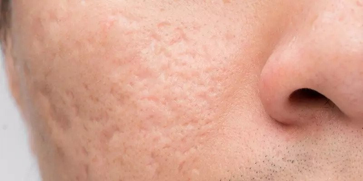 Rejuvenate Your Skin: Acne Scar Treatments in Dubai
