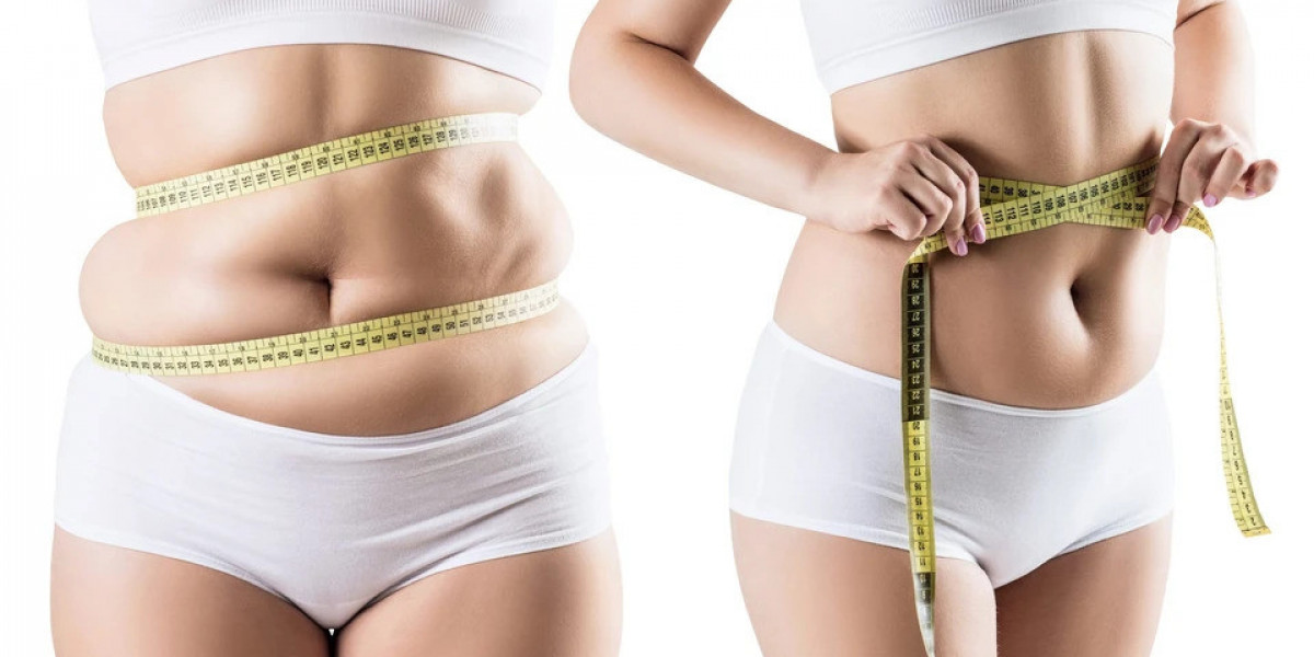 Reasons to Have Liposuction Surgery and Its Benefits