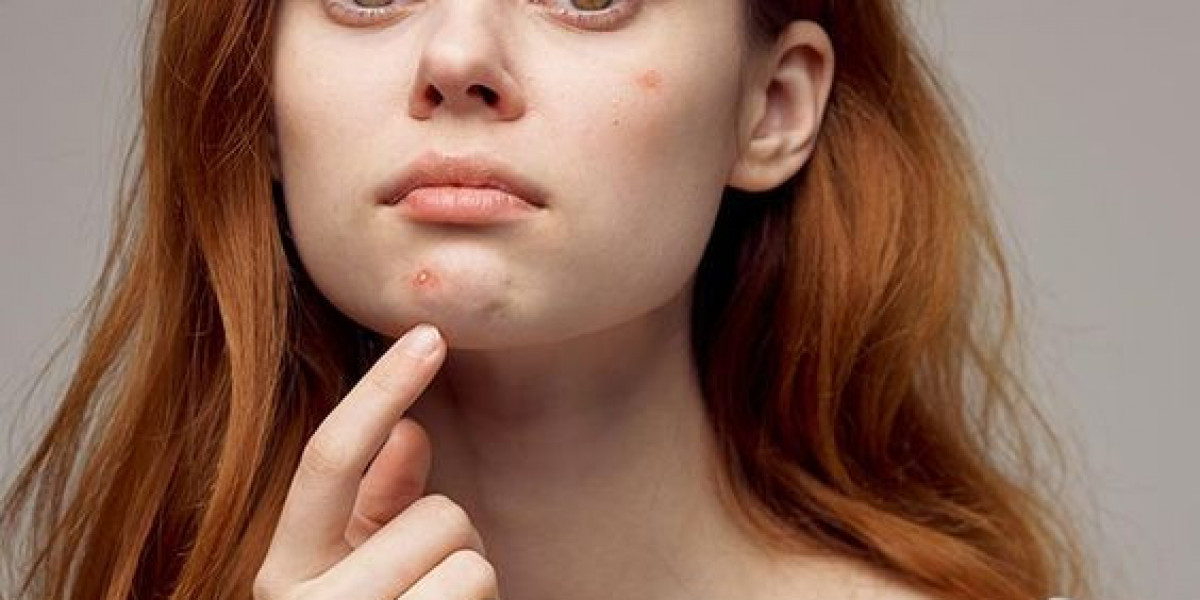 Acne Scars: Home Remedies & Modern-Day Treatments in Dubai