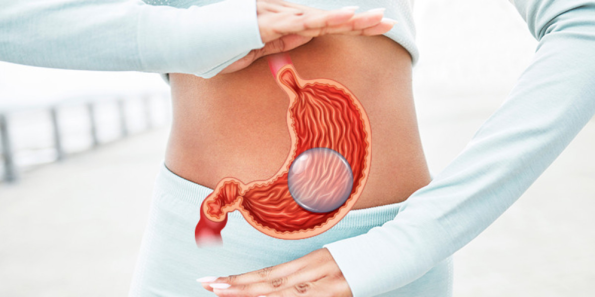 "Float Towards Wellness: The Promise of Gastric Balloon Weight Loss"