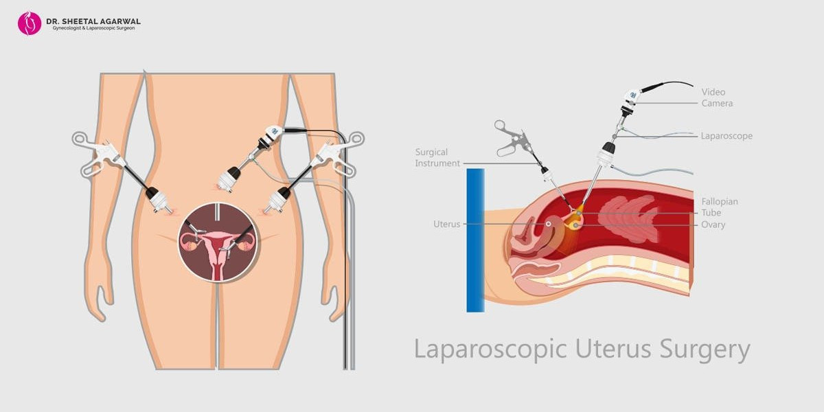 Laparoscopic Surgery: A Promising Avenue for Medical Tourism in Dubai