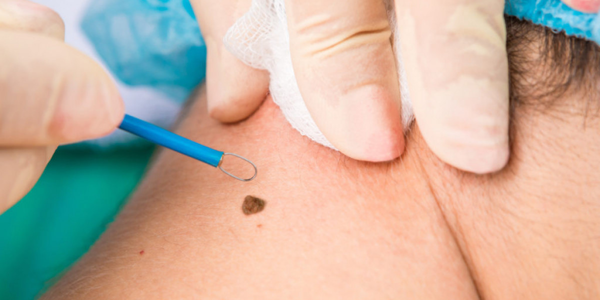 How to Prepare for Mole Removal Treatment 700 words edit
