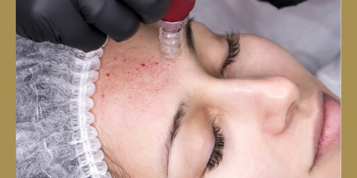 Dermapen Microneedling: A Non-Invasive Solution for Acne Scarring Woes