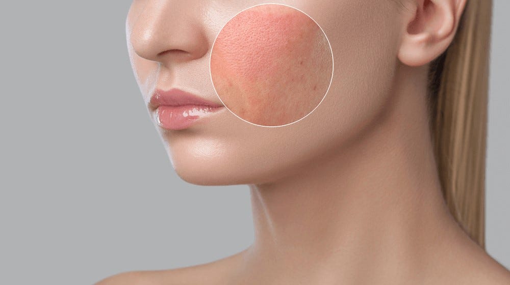 Why Dubai is a Top Destination for Rosacea Treatment | by Dynamic | May, 2024 | Medium