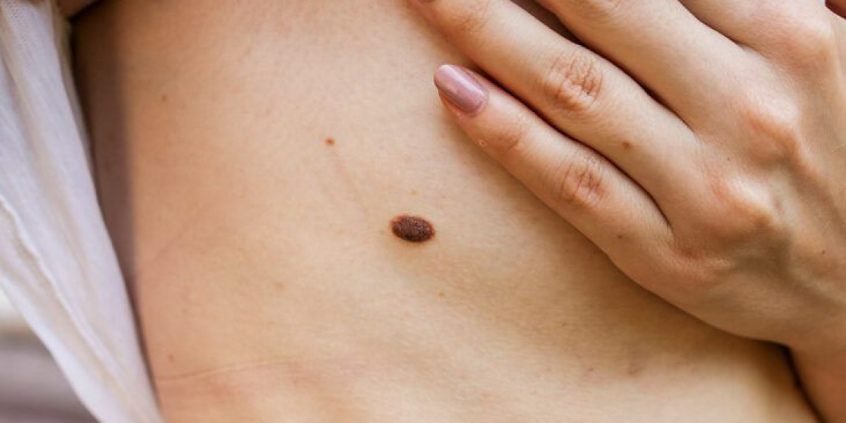 Non-Invasive Skin Tag Removal Methods in Dubai