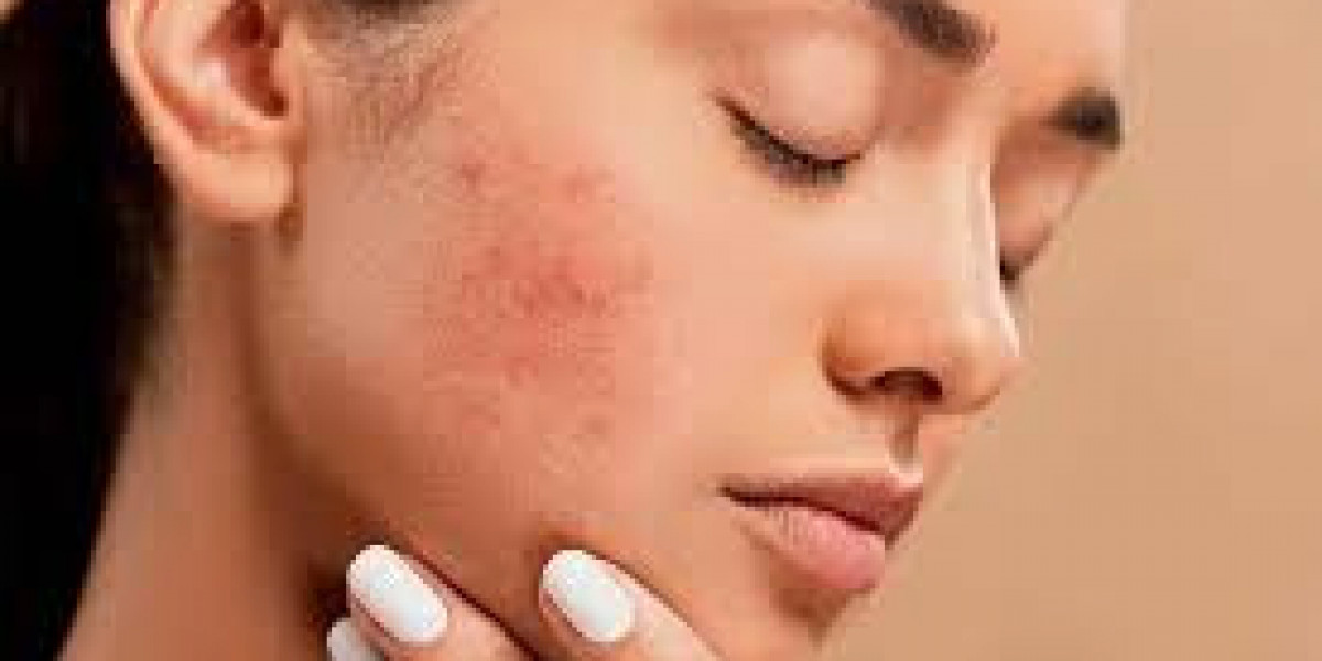 Who Can Benefit from Acne Treatment?