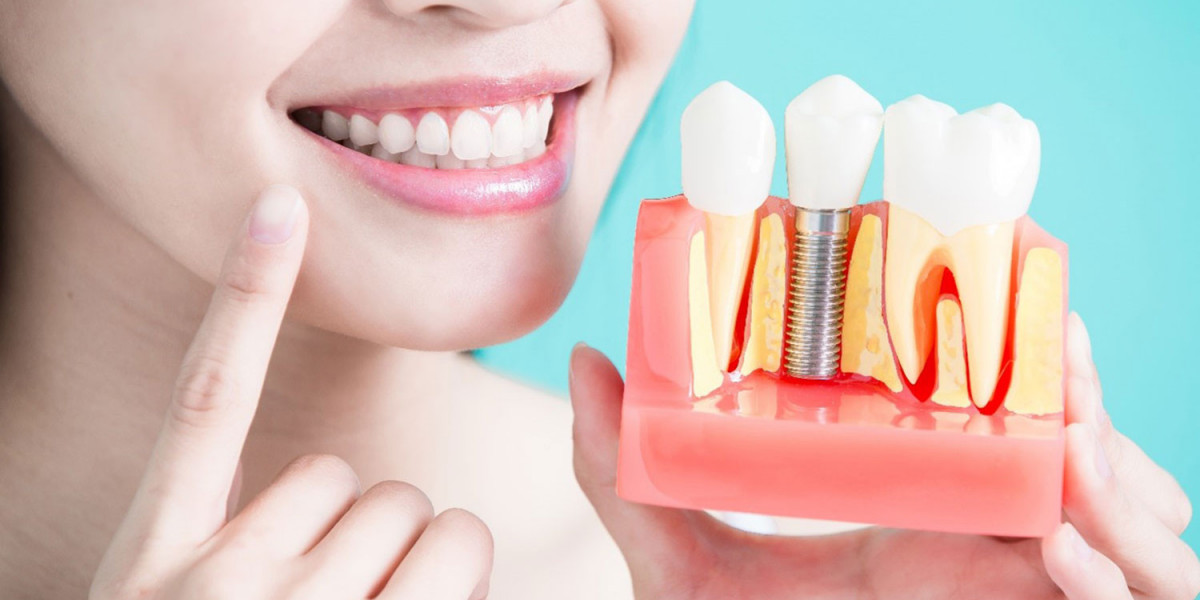 The Latest Trends in Dental Implants in Dubai