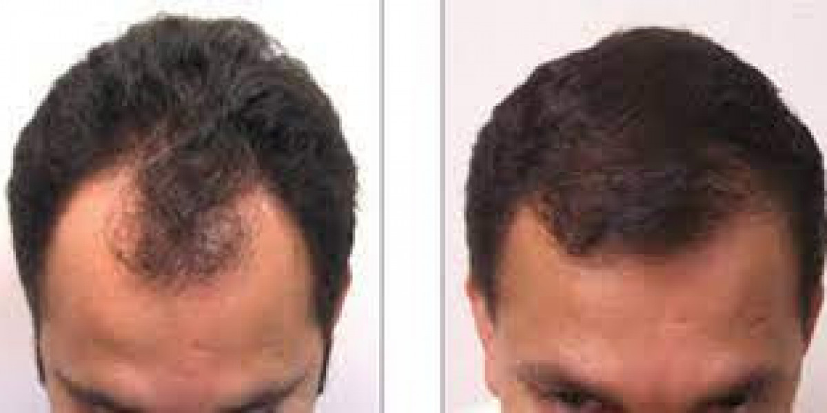 How to Prepare for Hair Restoration Surgery