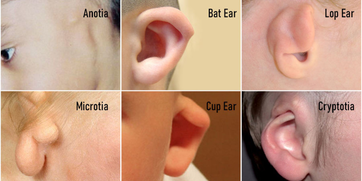 Different Types of Ear Deformities