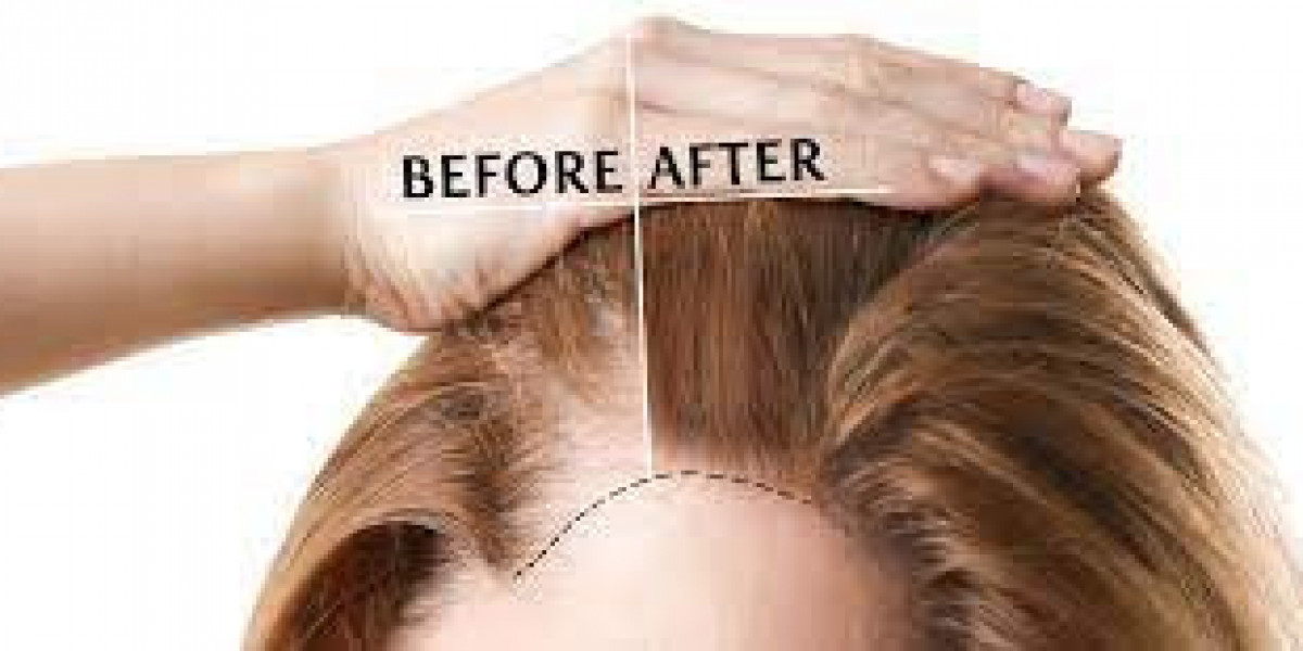 Care for Your Scalp After Hair Transplant