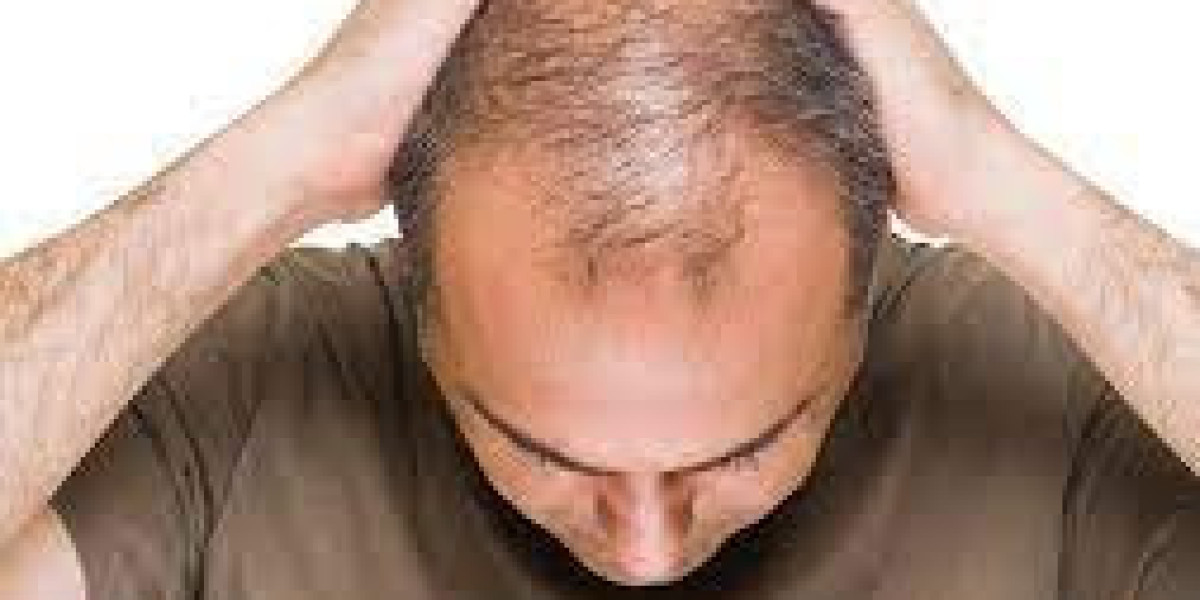 Should Your Wife See a Doctor About Her Hair Loss & Hair Transplant in Dubai
