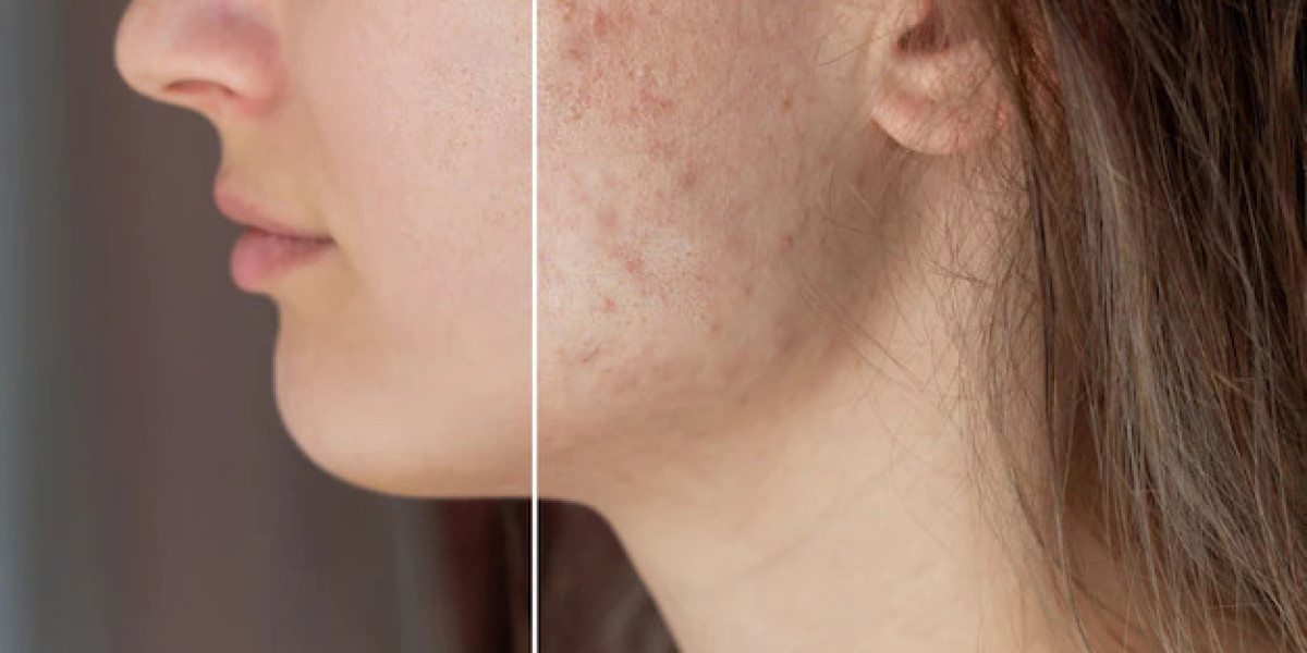 Unveiling the Best Acne Treatment Before and After Stories in Dubai