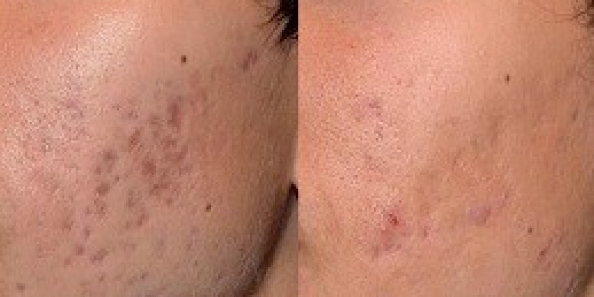 Pico Laser Treatment in Dubai: A Non-Invasive Solution for Clear Skin