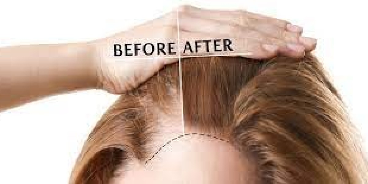 Surprising Benefits of Follicular Unit Extraction for Hair Transplant