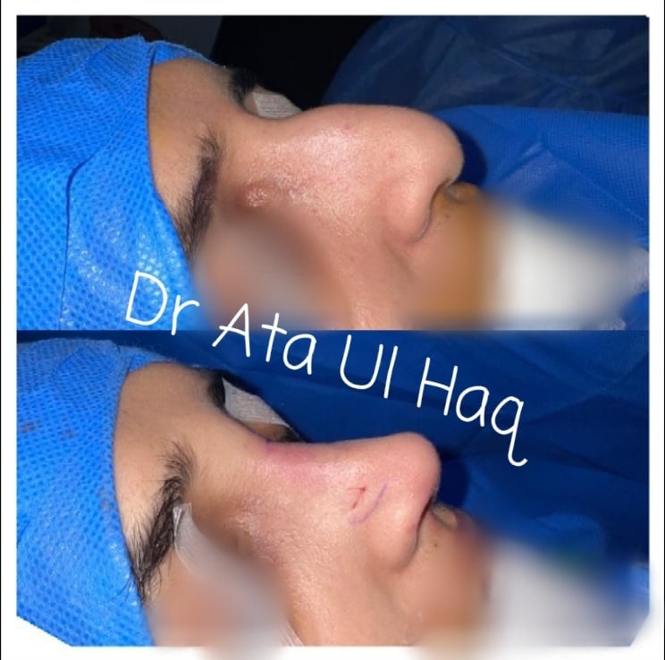 Rhinoplasty in Lahore - Nose Reshaping - Dr. Ata Plastic Surgeon