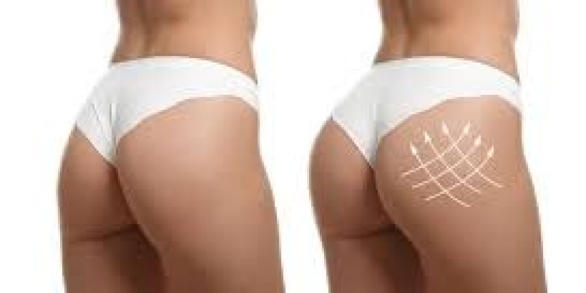 From Consultation to Recovery: Your Journey with Buttock Augmentation in Dubai
