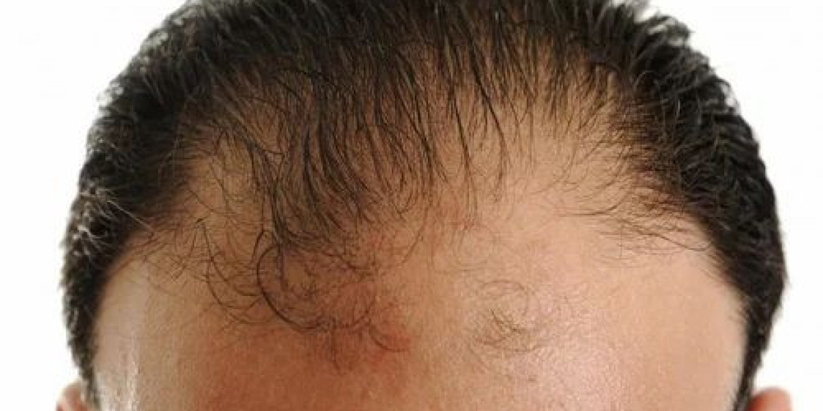 The Complete Guide to Hair Transplant Pricing in Dubai