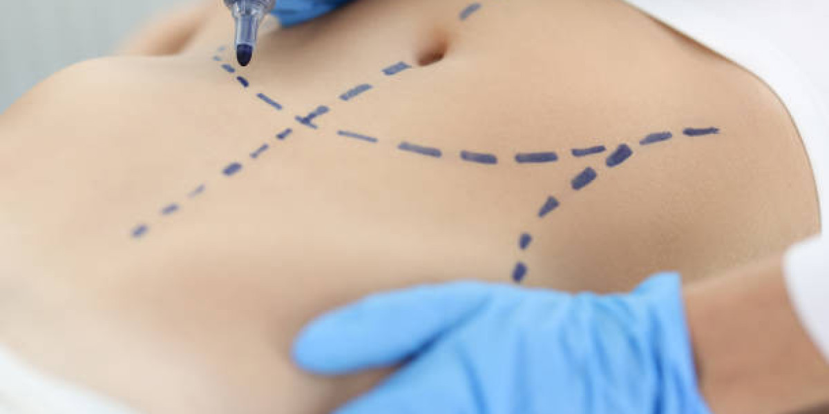 “Liposuction for Men: Addressing Stubborn Fat with Precision”