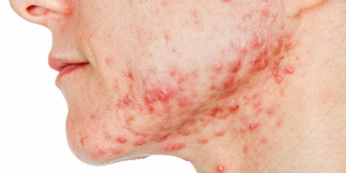 How Can Acne Be Treated? Learn Dermatologically Approved Treatments