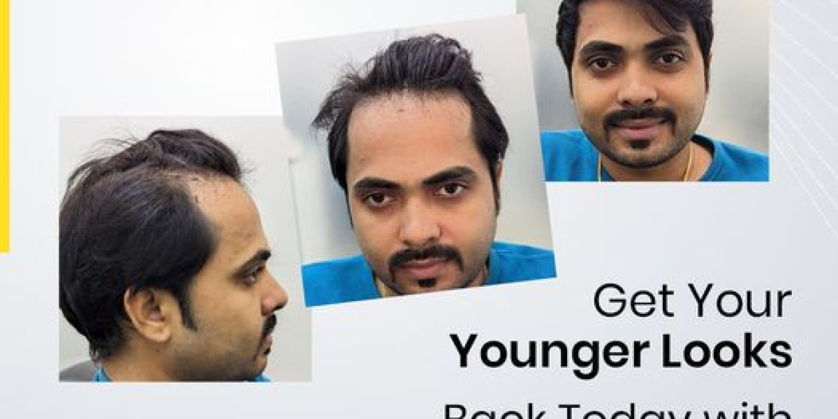 Hair Replacement Services in Hyderabad | Bglam Hair Studio