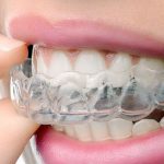 Sports Mouth Guards & Nightguards By Brampton Dentist - Polaris Dental