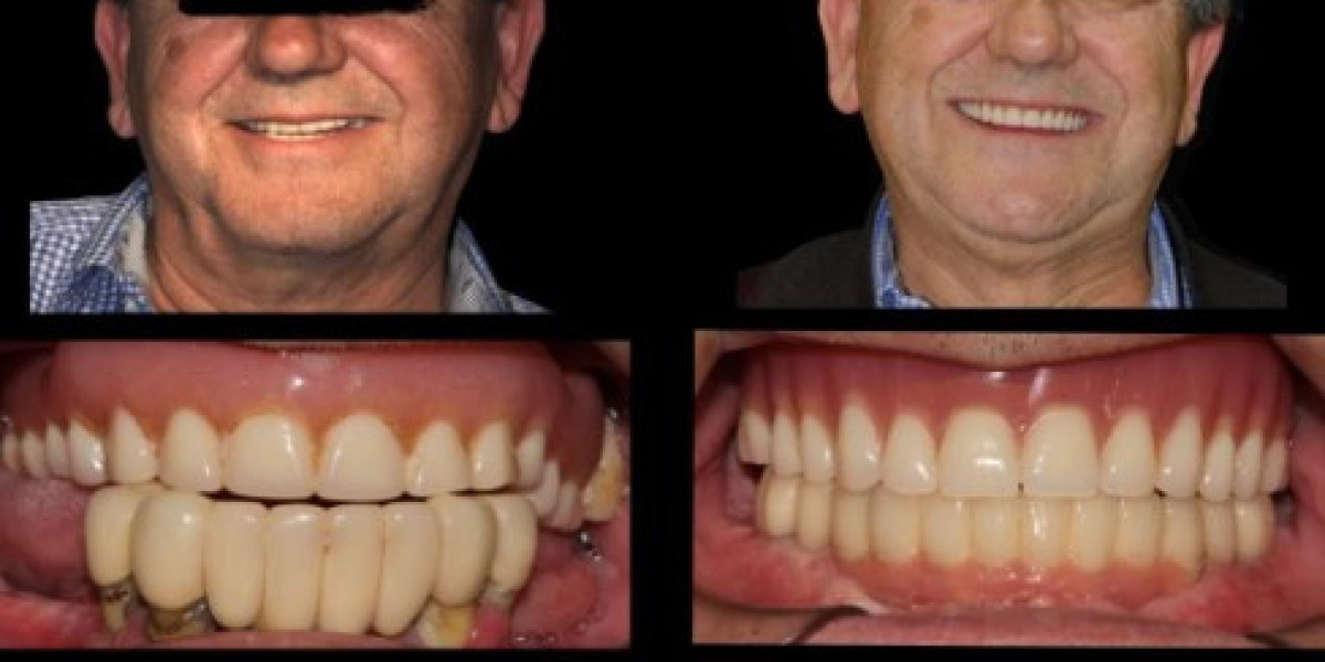 Implantes dentales en hospitalet de llobregat