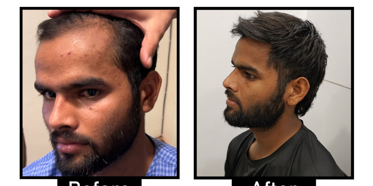 Best Hair Transplant Techniques in Delhi NCR for Natural Results