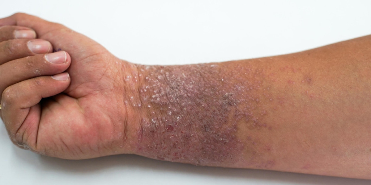 How do you get rid of Atopic Dermatitis?