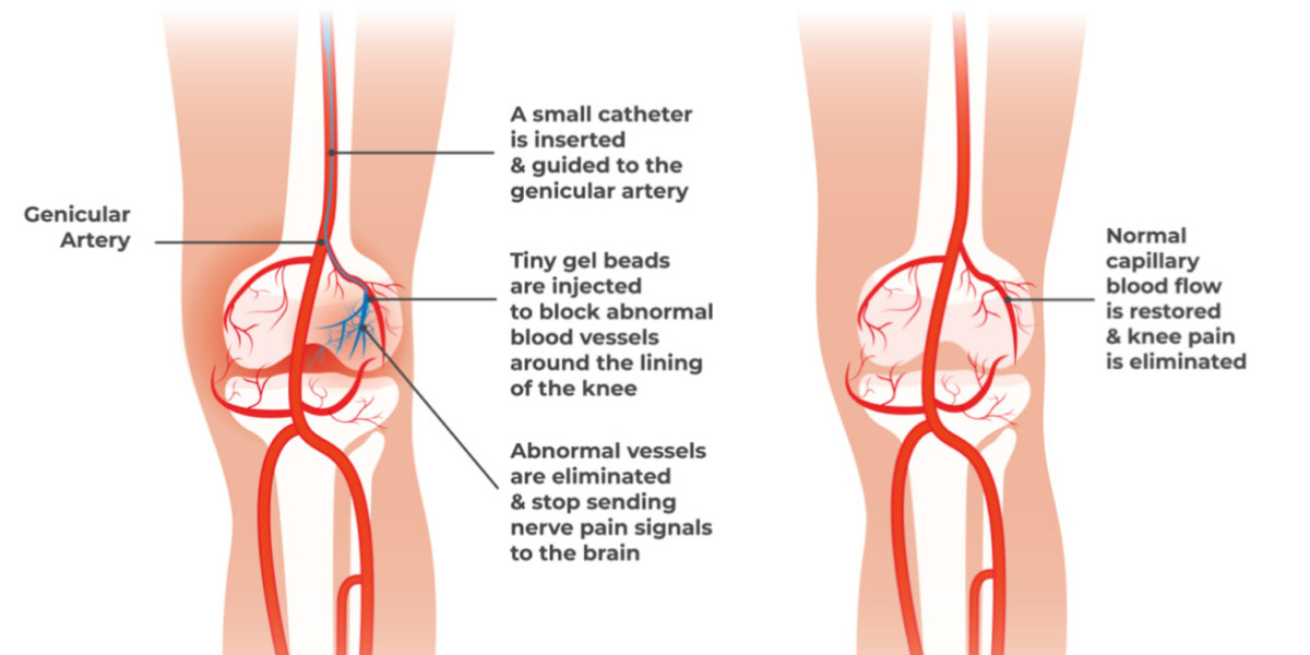 Understanding Genicular Artery Embolization: A Comprehensive Overview by Flowcare