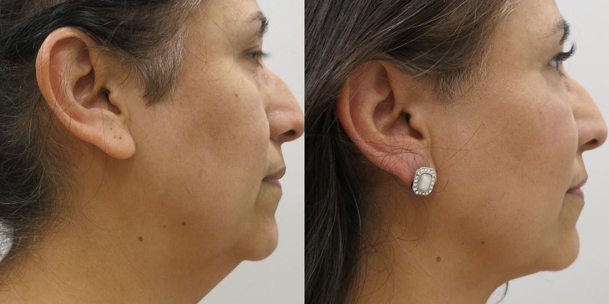 Neck Liposuction vs. Laser Fat Removal: What to Expect Before and After