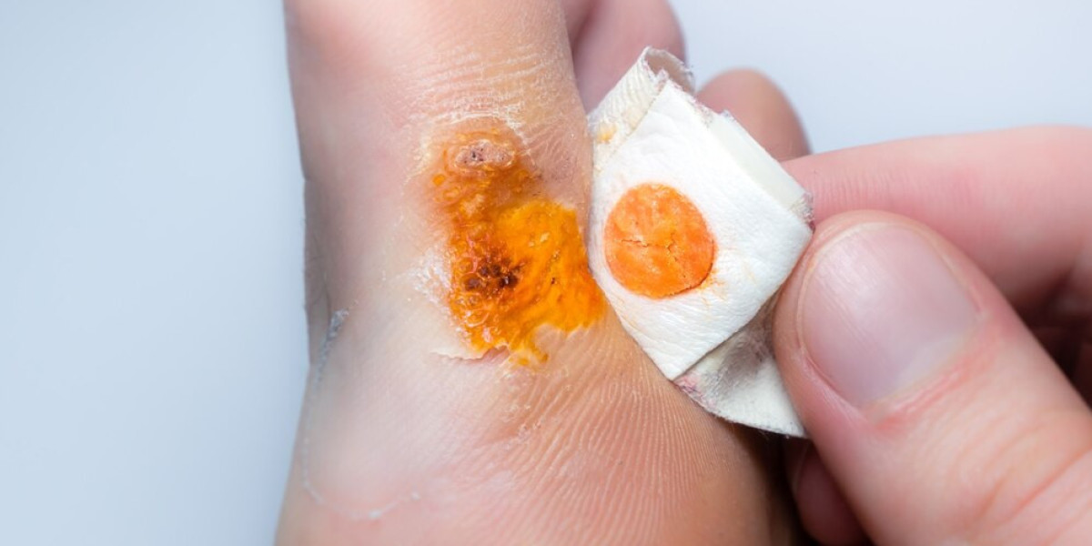 Effective Long-Term Solutions for Corns and Warts Treatment in San Antonio