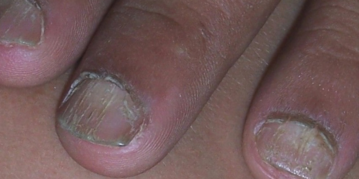 Is Nail Avulsion Surgery Painful?