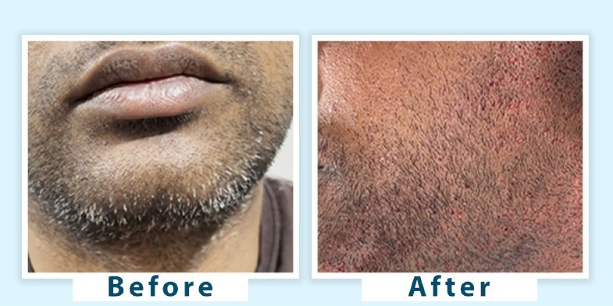 Best Grey Beard Treatment Options to Restore Natural Color