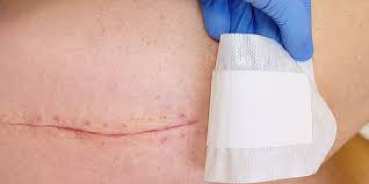 Stitch Removal: Pain Myths Debunked