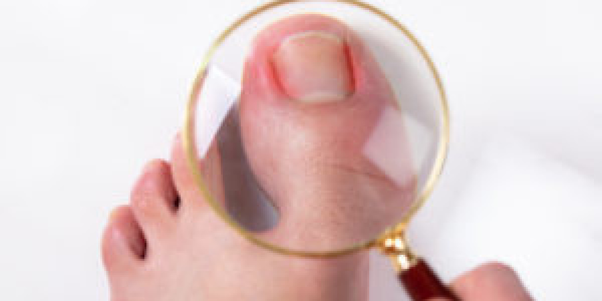 Expert Insights on Ingrown Toenail Removal in San Antonio