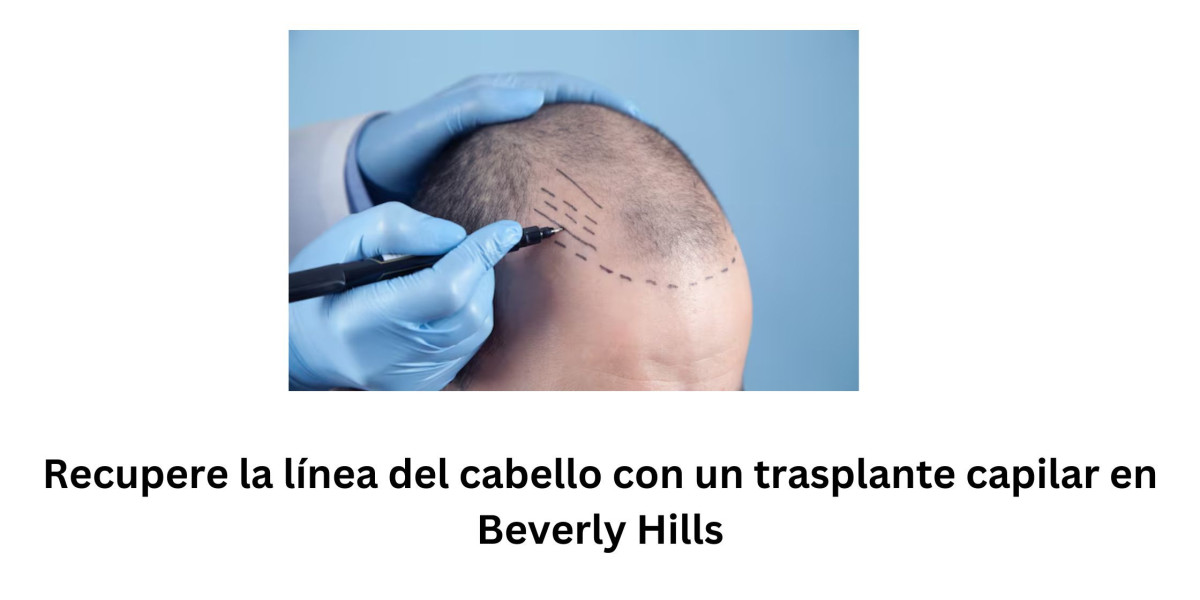 Recupere la línea del cabello con un trasplante capilar en Beverly Hills