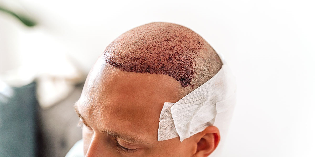 Baldness and Aging: How Hair Transplants Can Help