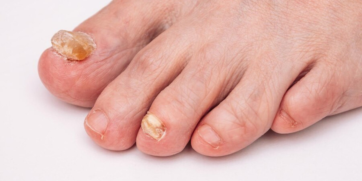 Spain Onychomycosis Market: Trends, Growth Opportunities, and Forecast Analysis