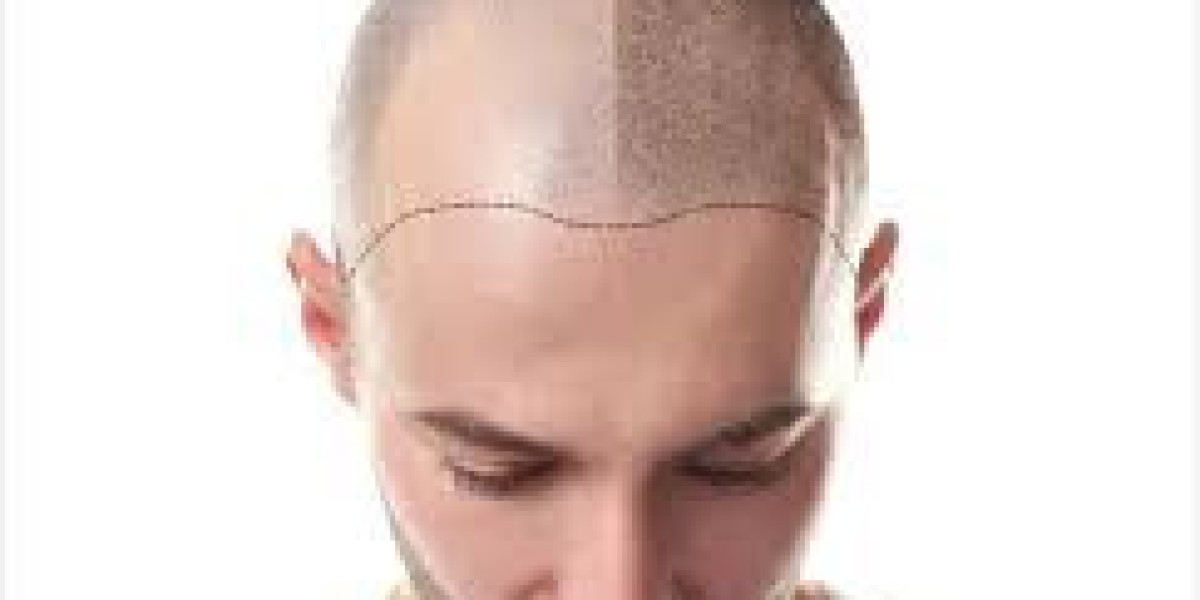 Baldness and Aging: How Hair Transplants Can Help