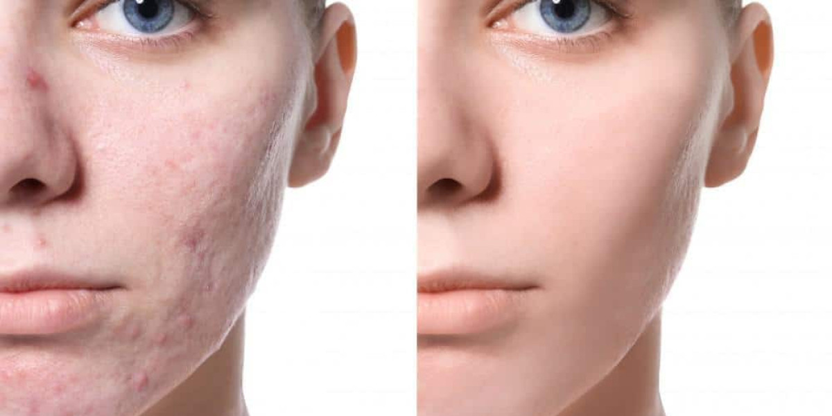 Microneedling vs Laser Treatments: Which is More Effective for Acne Scars