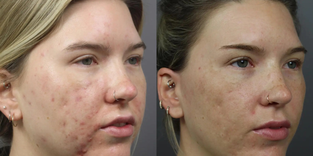 Exploring the Benefits of Fractional Laser for Acne Scars in Duba