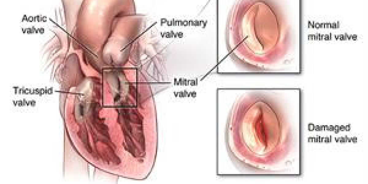 Navigating the Cost of Heart Valve Replacement Surgery in India