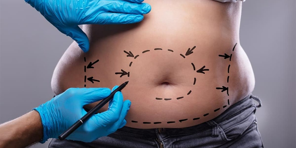 Bariatric Surgery for Teenagers: Is It Available in Dubai