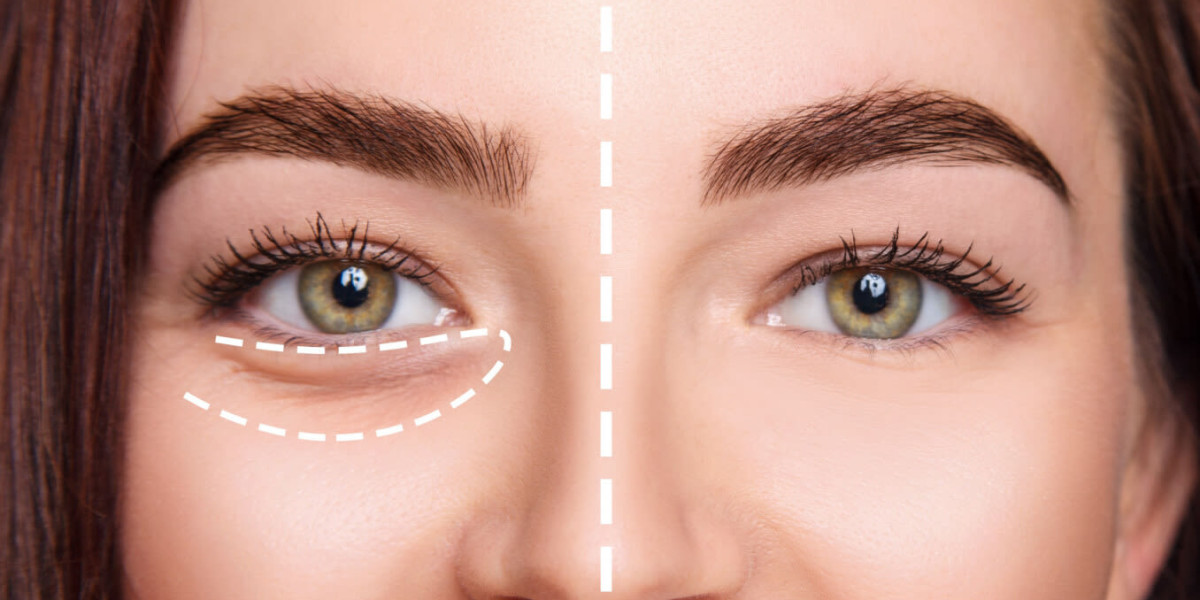 Will be Under Eye Filler Safe? Every little thing People Should Know