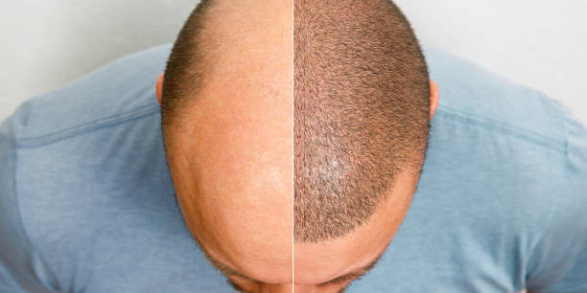 Hair Transplant Karachi Cost – A Comprehensive Guide