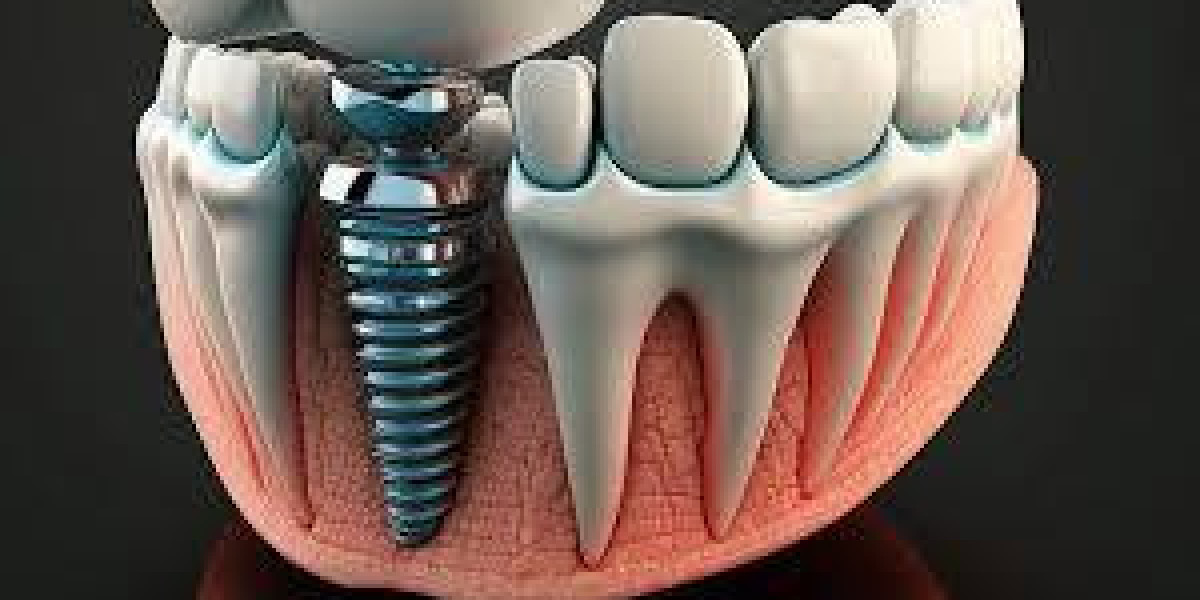 Restore Your Smile with Advanced Dental Implant Solutions