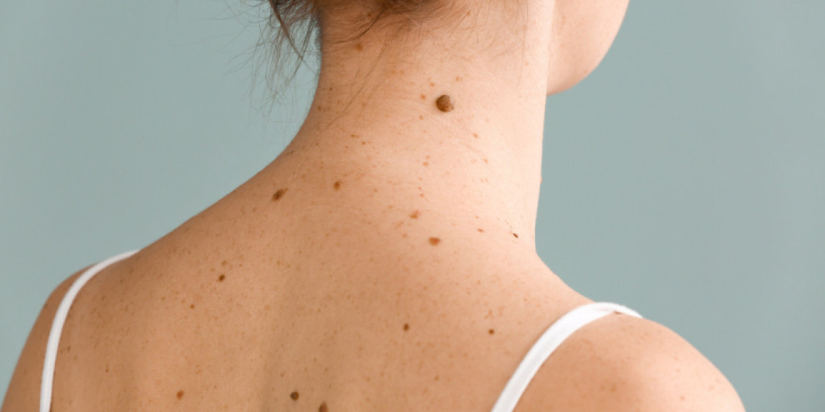 The Healing Process of Birthmark Removal in Dubai: What to Expect