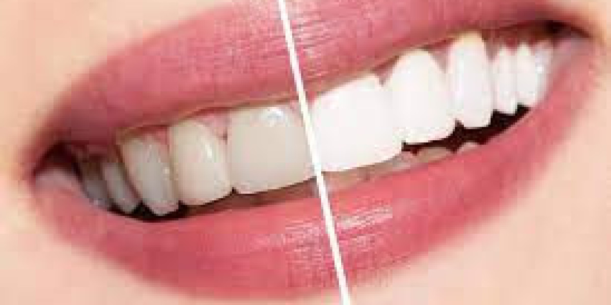 Will My Smoking Habits Affect Teeth Whitening Results in Dubai