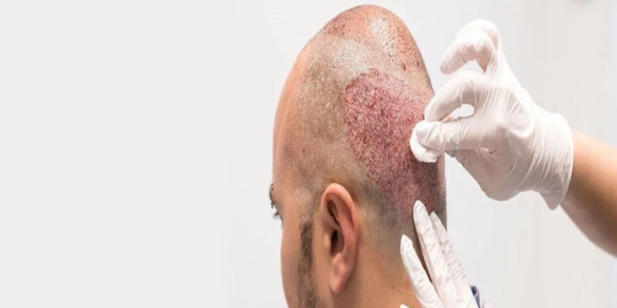 What Makes FUE Hair Transplants So Popular?